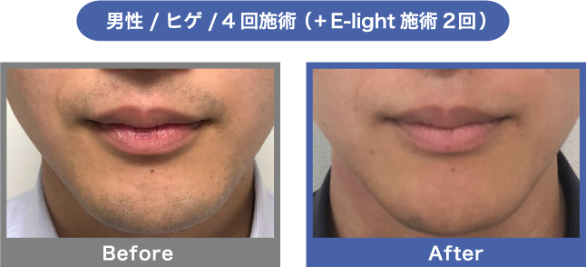 BeforeAfter男性ヒゲ