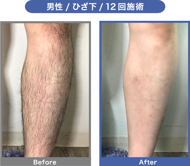 BeforeAfter男性ひざ下